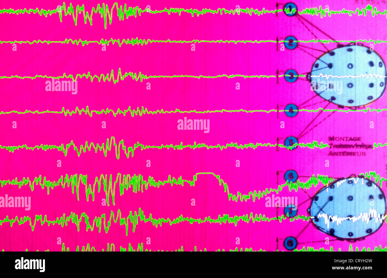 EPILEPSIE, EEG Stockfoto