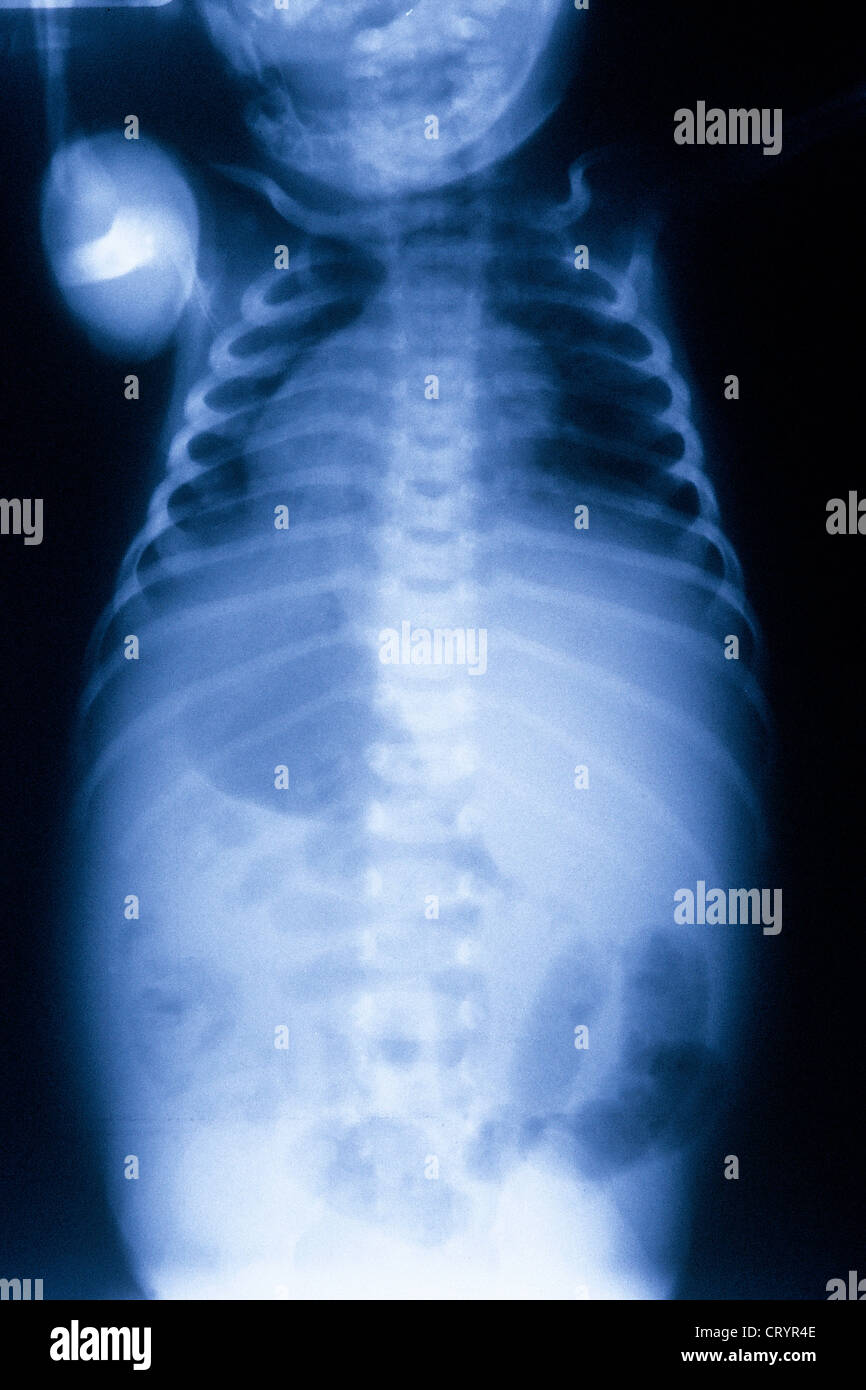 BAUCHFELLENTZÜNDUNG, X-RAY Stockfoto