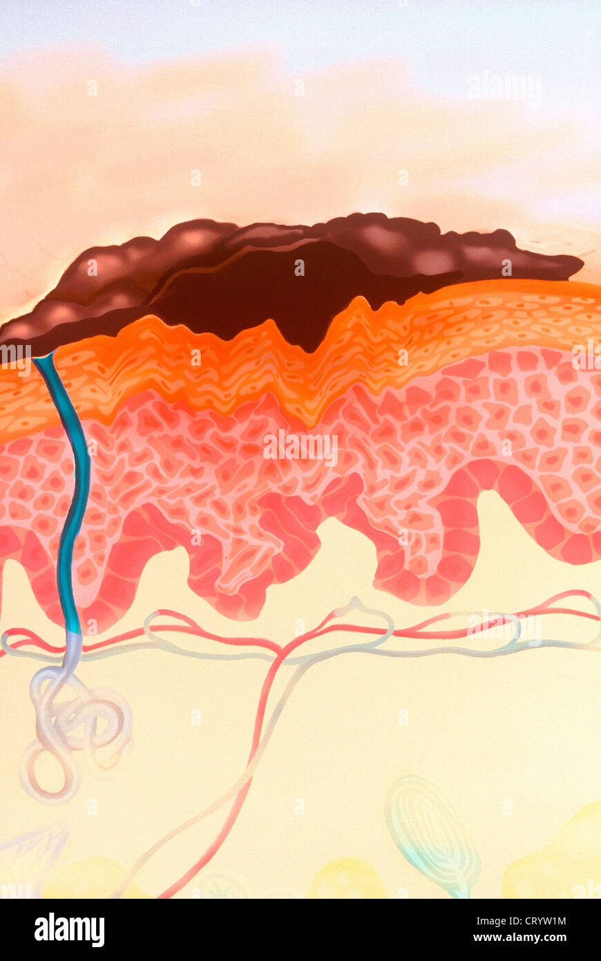 HAUTKREBS, ZEICHNUNG Stockfoto