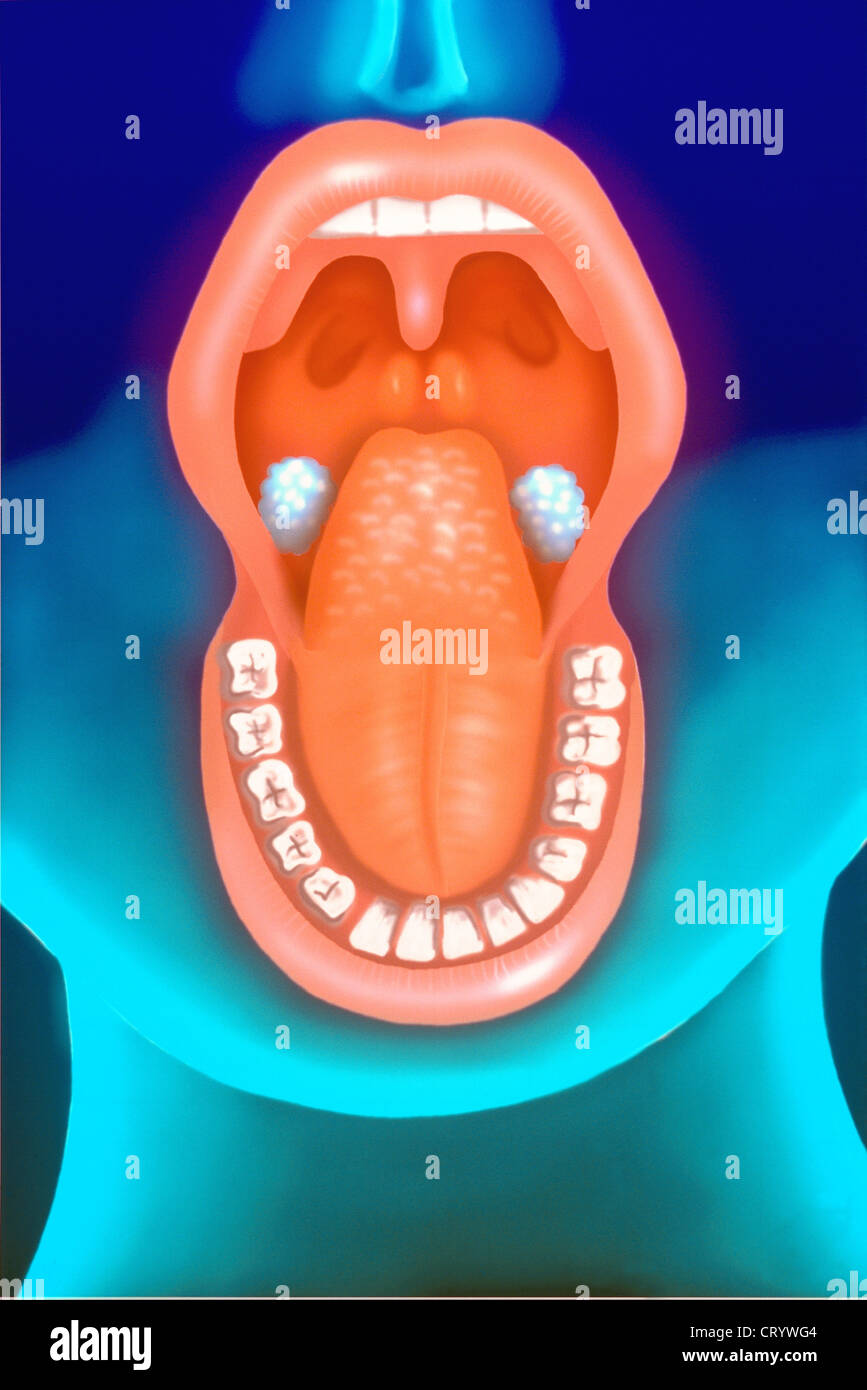 TONSILLEN, ZEICHNUNG Stockfoto
