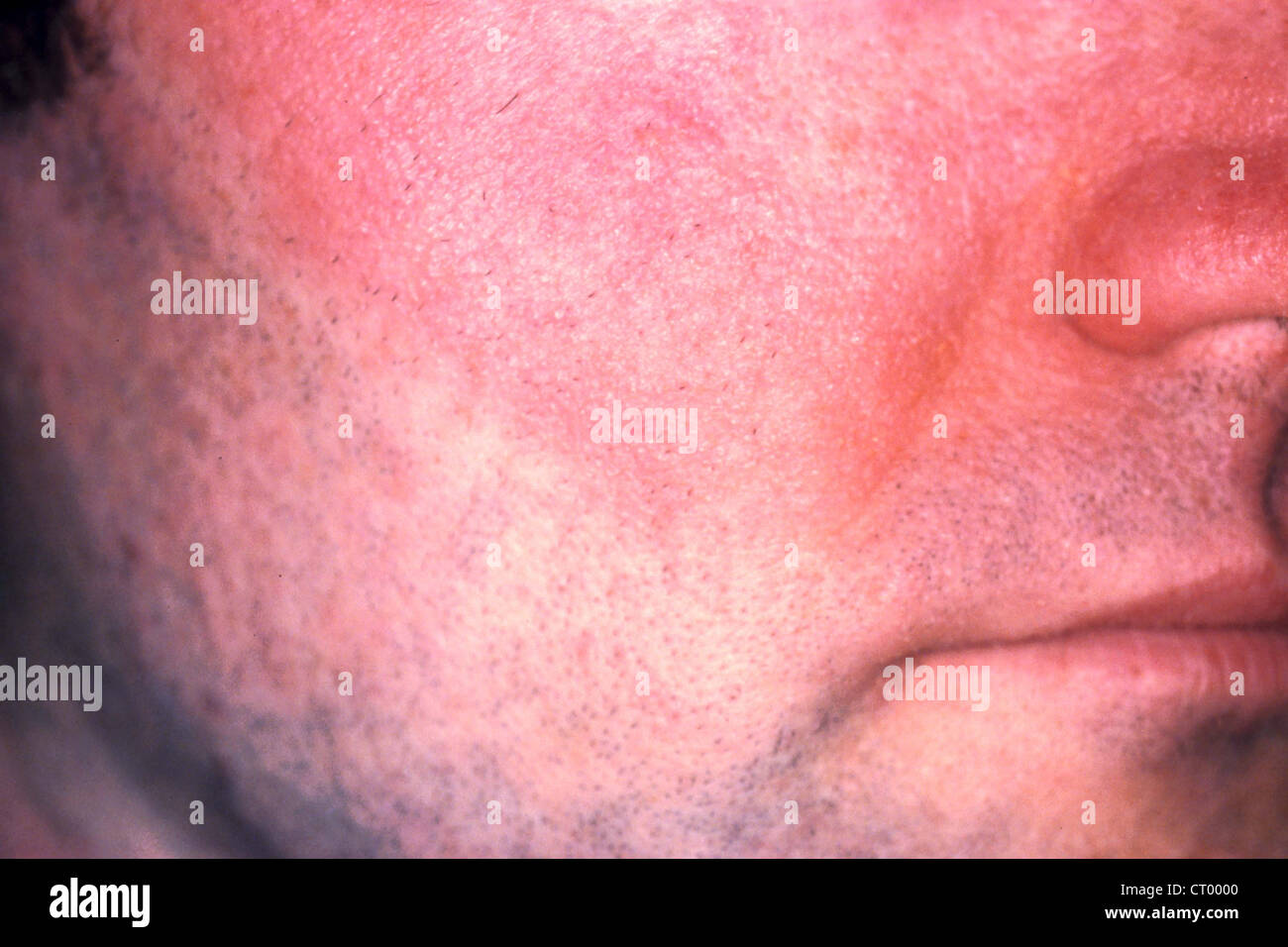 KONTAKTDERMATITIS. Stockfoto