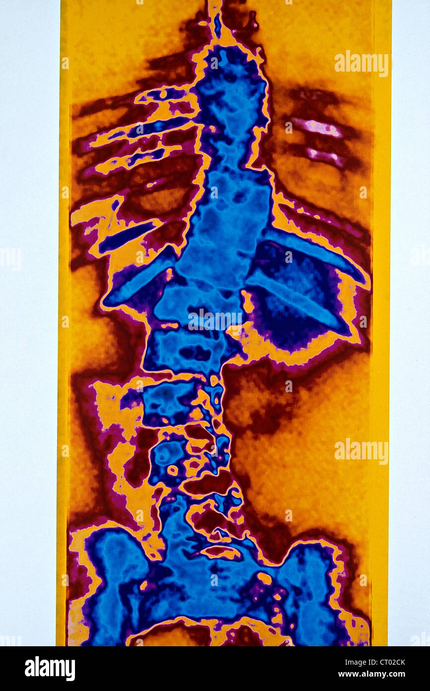 SKOLIOSE, X-RAY Stockfoto