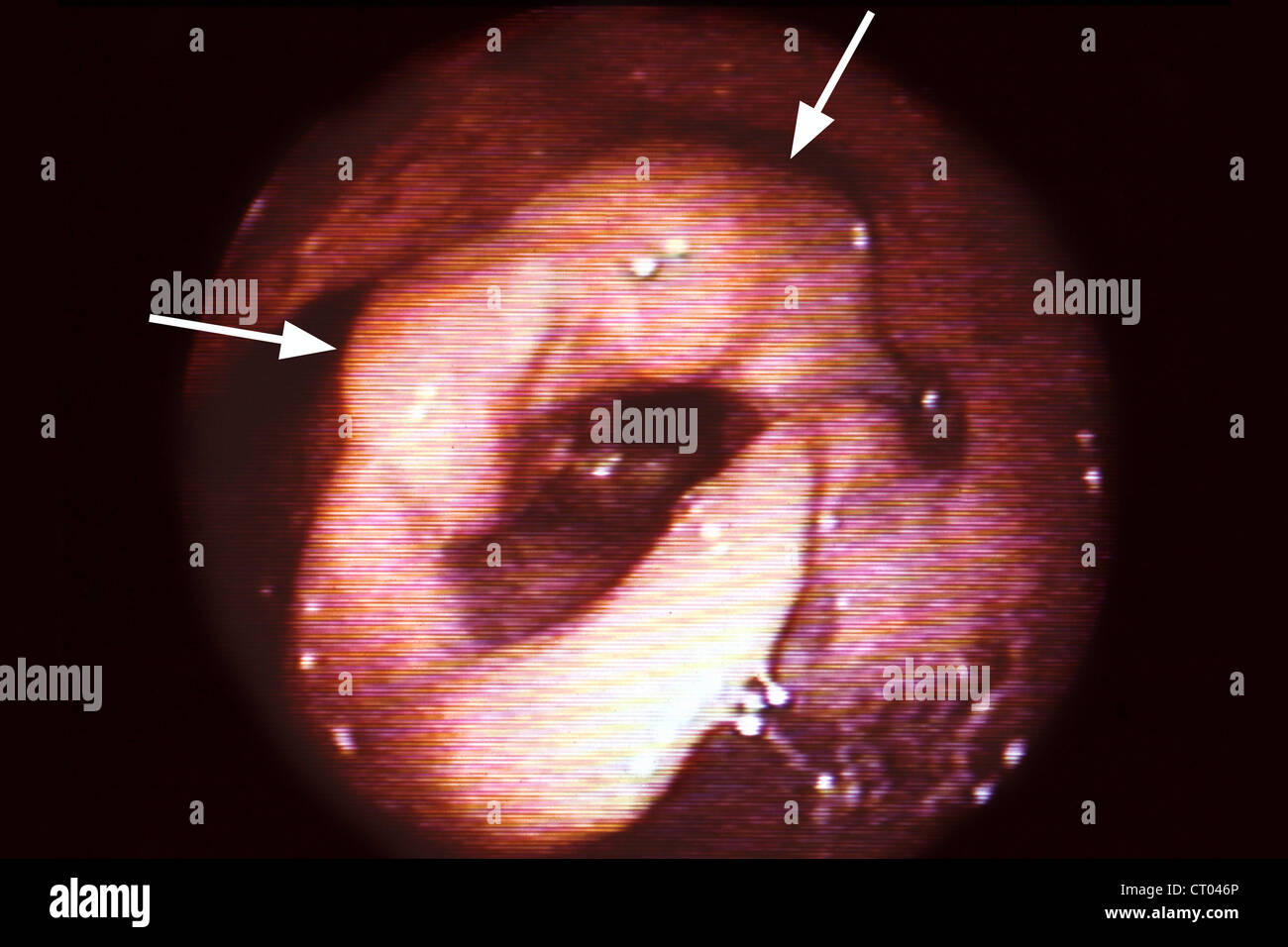 KEHLKOPFKREBS Stockfoto