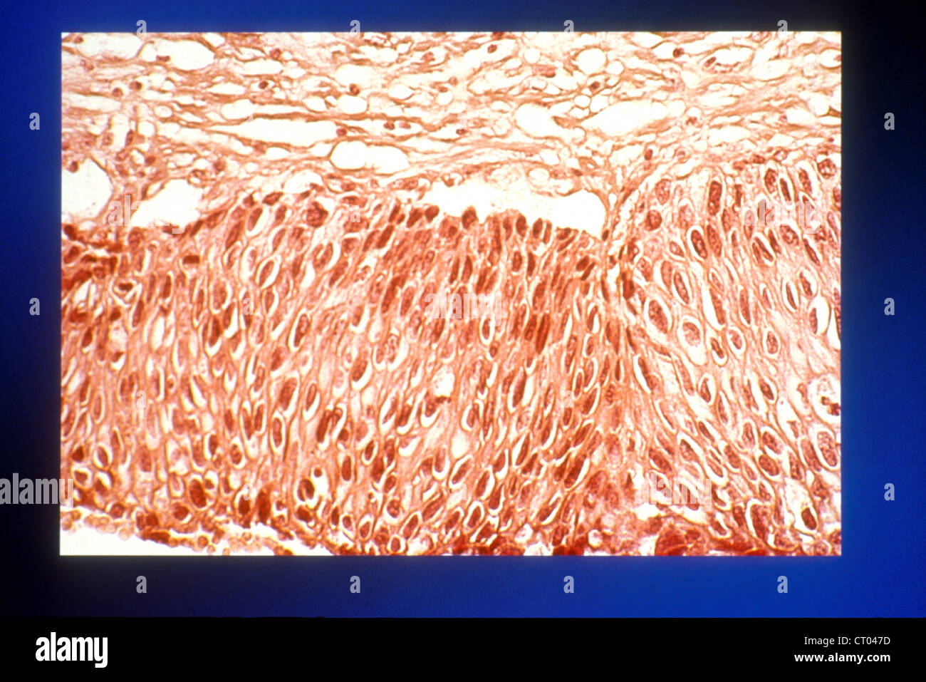 KREBS DER GEBÄRMUTTER, HISTOLOGIE Stockfotografie - Alamy