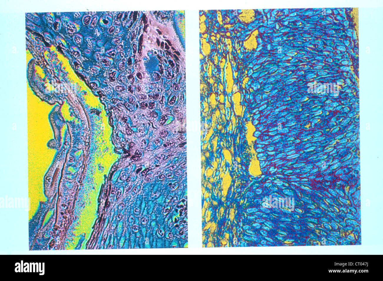 KREBS DER GEBÄRMUTTER, HISTOLOGIE Stockfotografie - Alamy