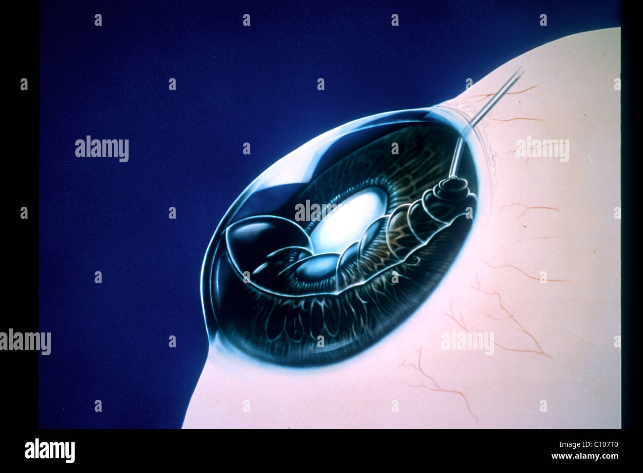 Hornhaut transplantation -Fotos und -Bildmaterial in hoher Auflsung  Alamy