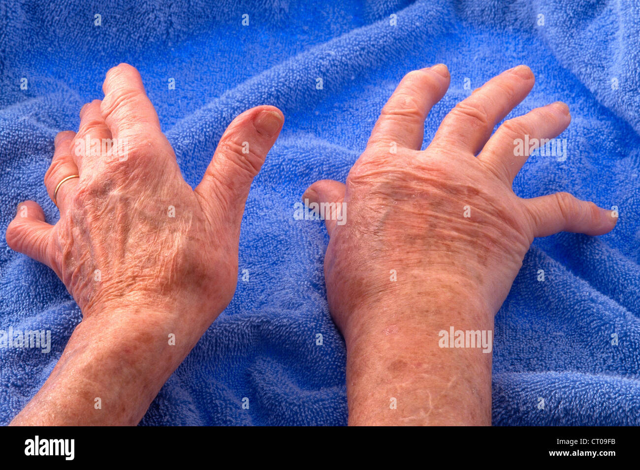 HAND ARTHROSE Stockfoto