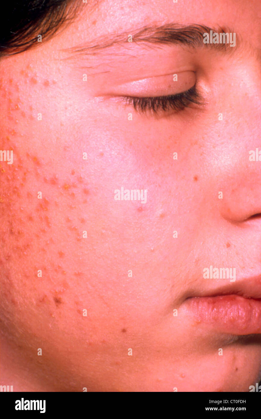 Pyoderma Fotos und Bildmaterial in hoher Auflösung Alamy