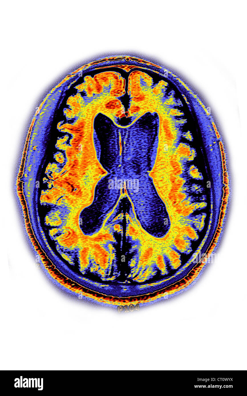 ALZHEIMER-KRANKHEIT, MRT Stockfoto