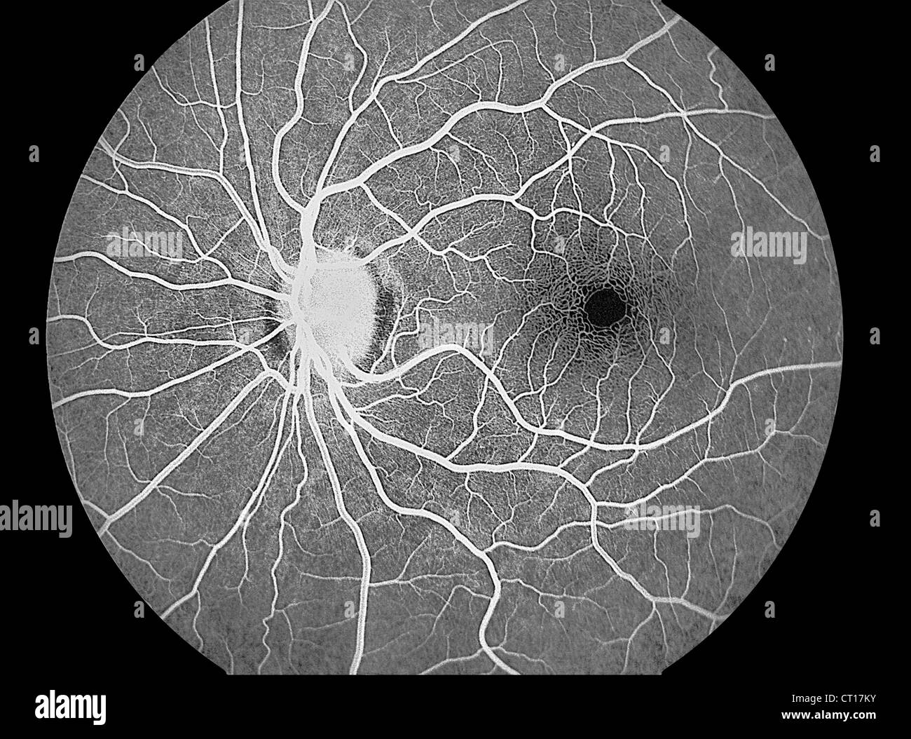 DIABETISCHE RETINOPATHIE Stockfotografie - Alamy