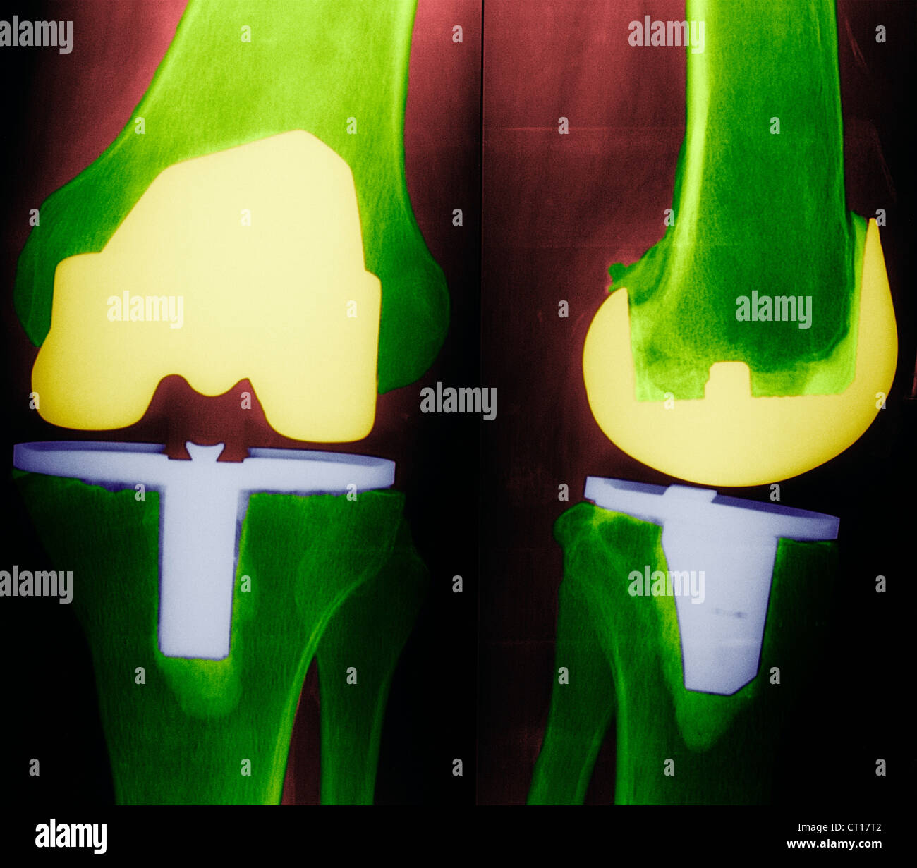 KNIEPROTHESE, X-RAY Stockfoto