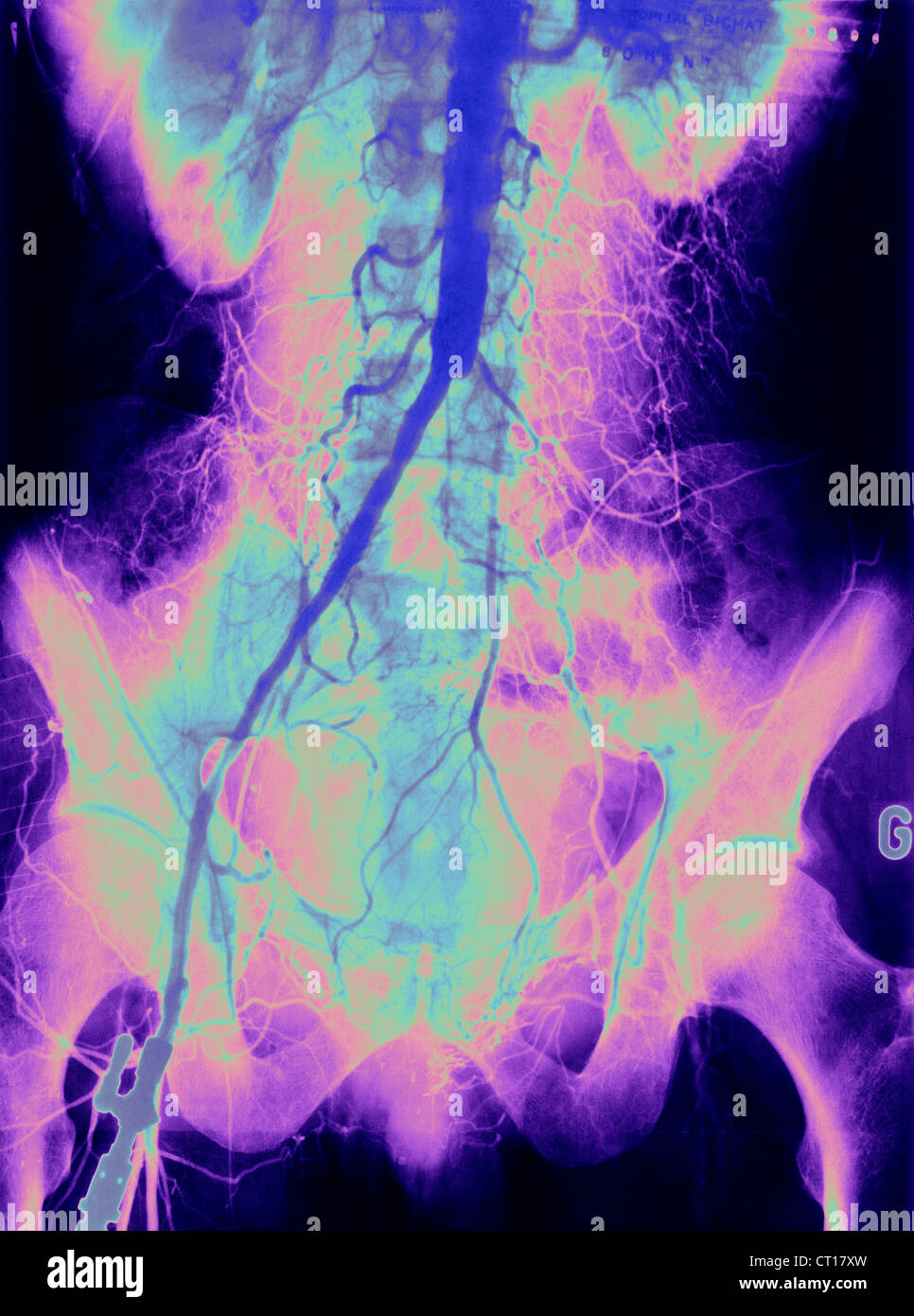 Arterielle thrombose Fotos und Bildmaterial in hoher Auflösung Alamy