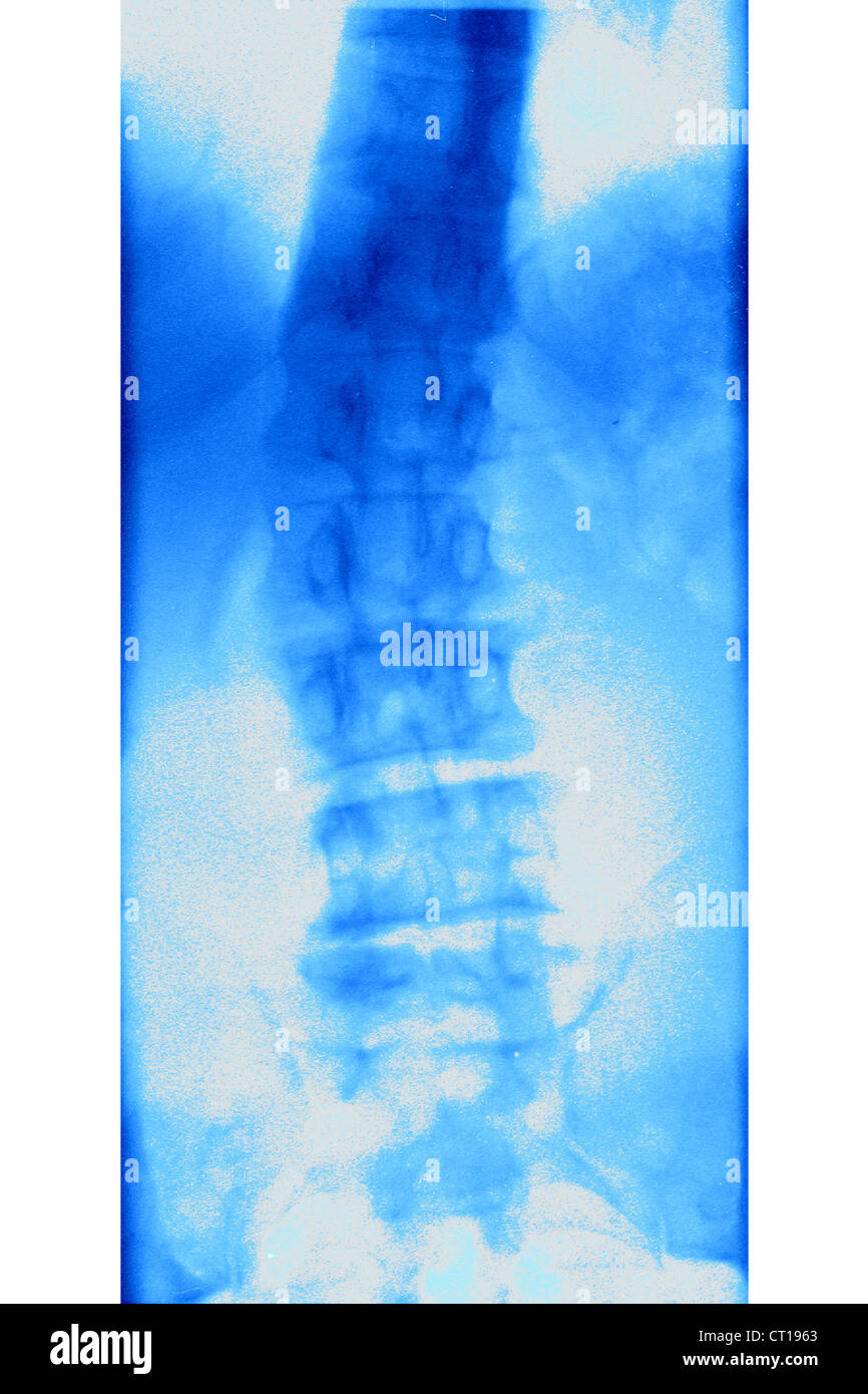 SKOLIOSE, X-RAY Stockfoto