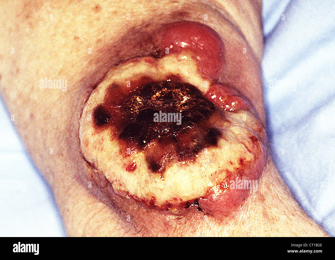 BÖSARTIGER TUMOR DER HAUT Stockfoto, Bild 49203126 Alamy