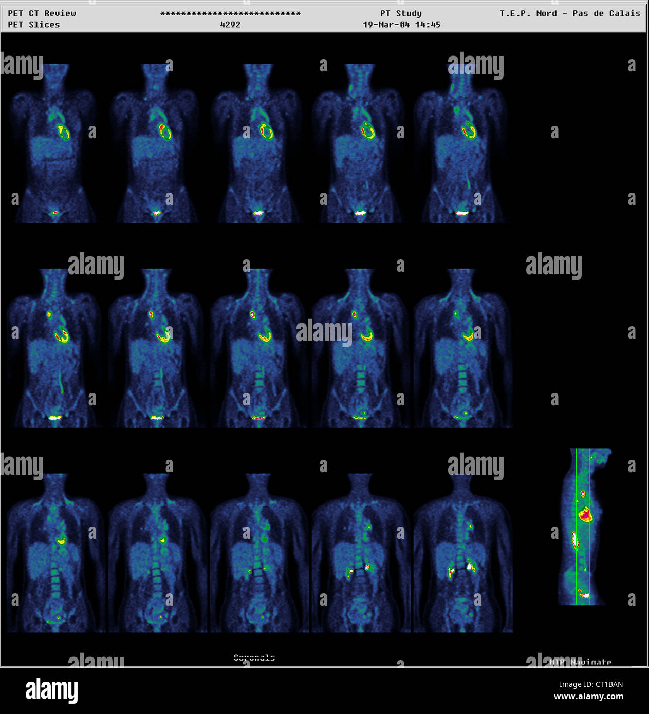 Emissionstomographien Fotos und Bildmaterial in hoher Auflösung Alamy