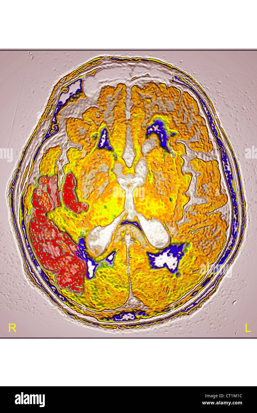 INTENSIVPFLICHTIGE ZEREBRALE ISCH MIEN visual data 3