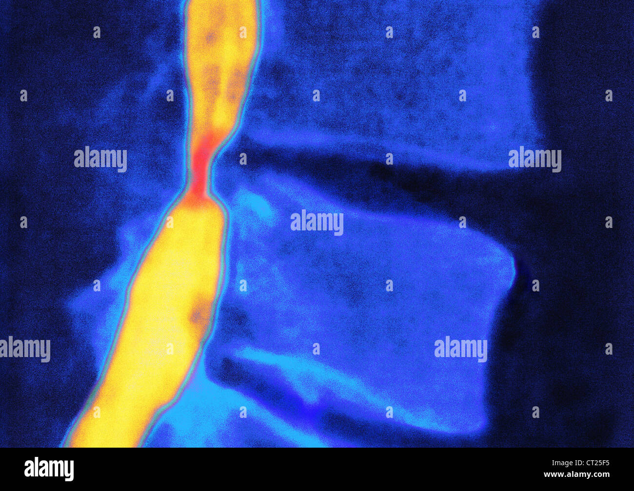 BANDSCHEIBENVORFALL, X-RAY Stockfoto