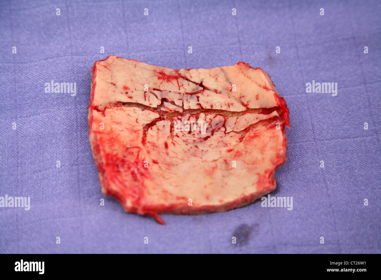 MENINGEOM-OPERATION Stockfoto