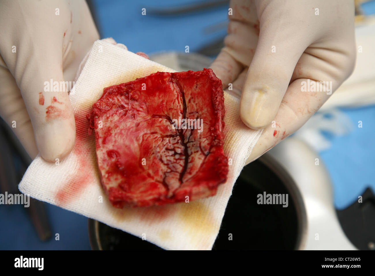 MENINGEOM-OPERATION Stockfoto