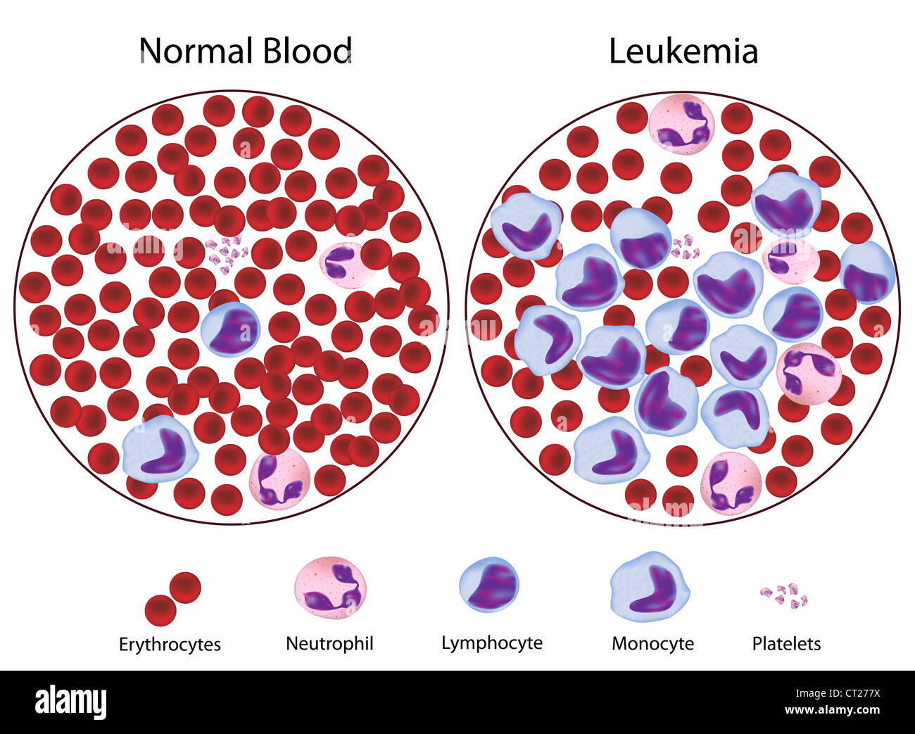 Leukämie im Vergleich zu normalem Blut Stockfotografie Alamy