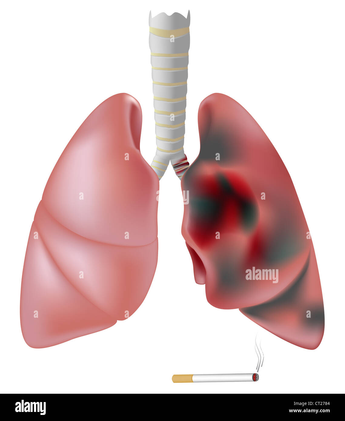 Raucherlunge Vs. Gesunde Lunge Arztbrief Der Woche: COPD – Atmen Wie