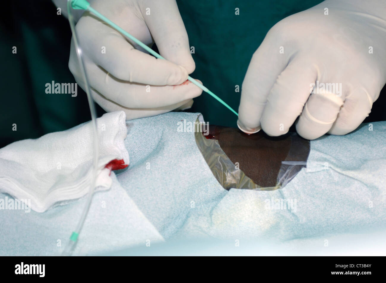Die Kardiologe spült wieder eine Kochsalzlösung durch den Katheter. Beachten Sie die