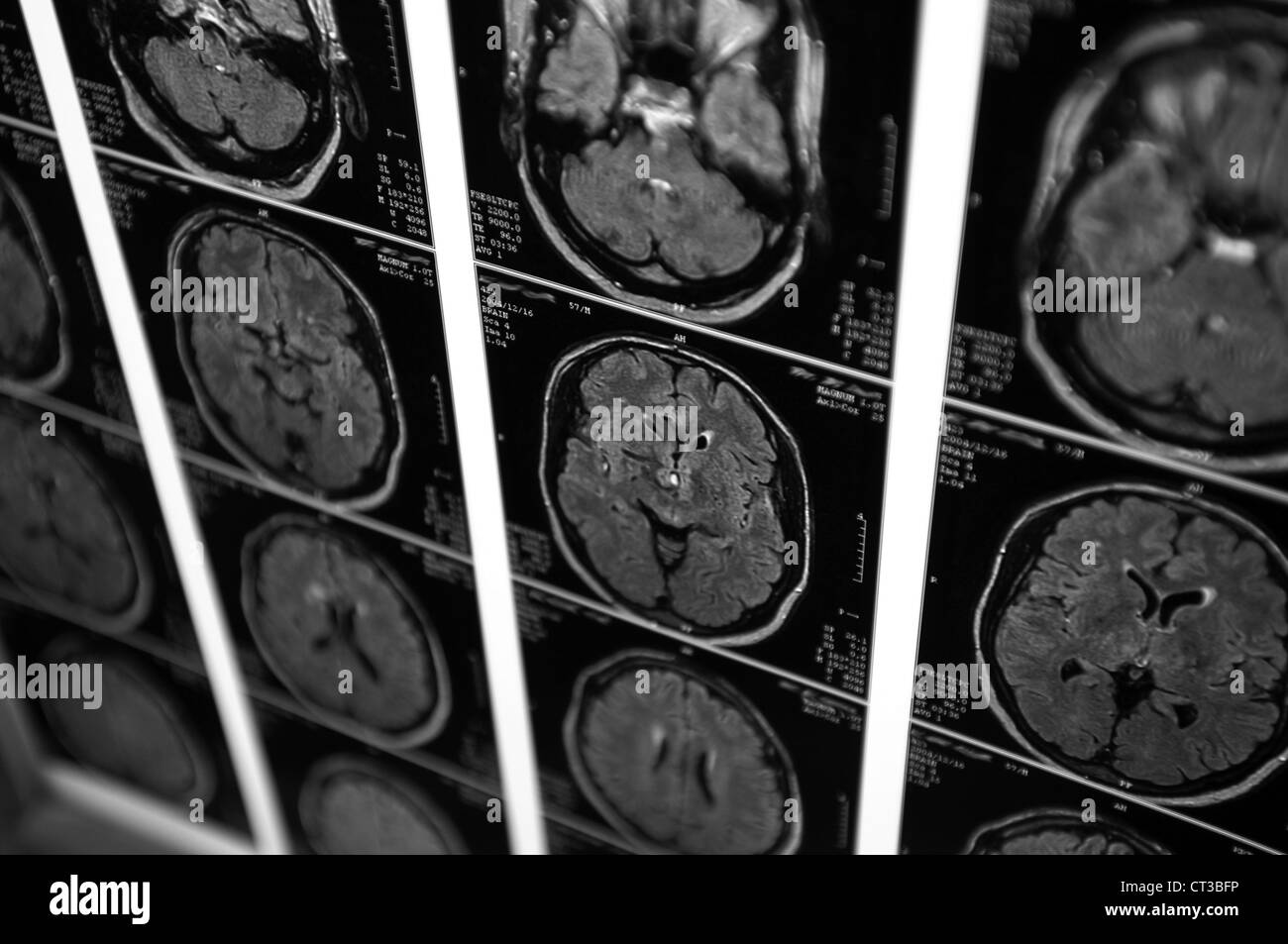 Eine Reihe von Kopf CT (Computertomographie) Scans von einem jungen Mann. Stockfoto