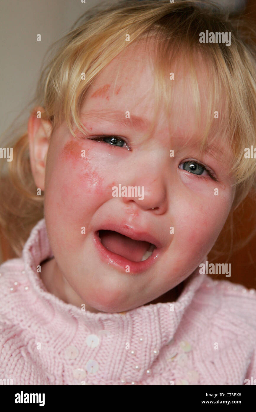 WUNDE, KIND Stockfoto