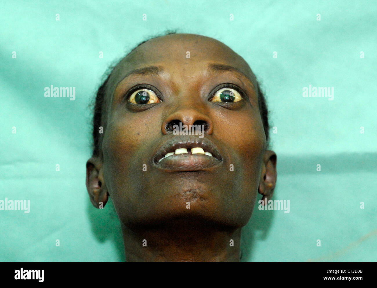Eine Frau mit Morbus Basedow (Morbus Basedow-Graves) Stockfoto