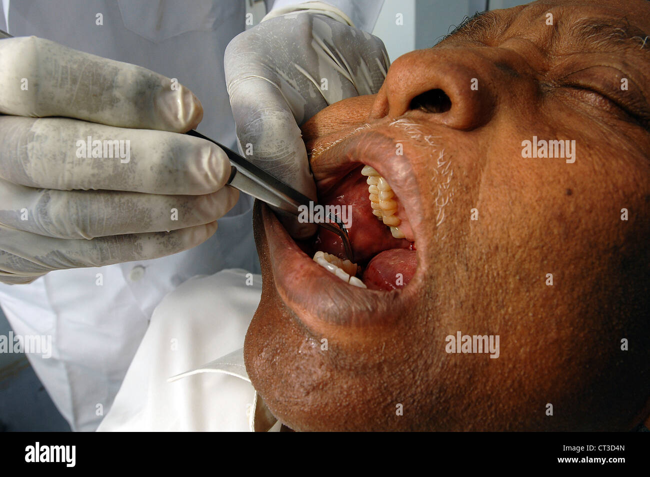 Ein Mann erfährt endodontische Chirurgie Stockfoto