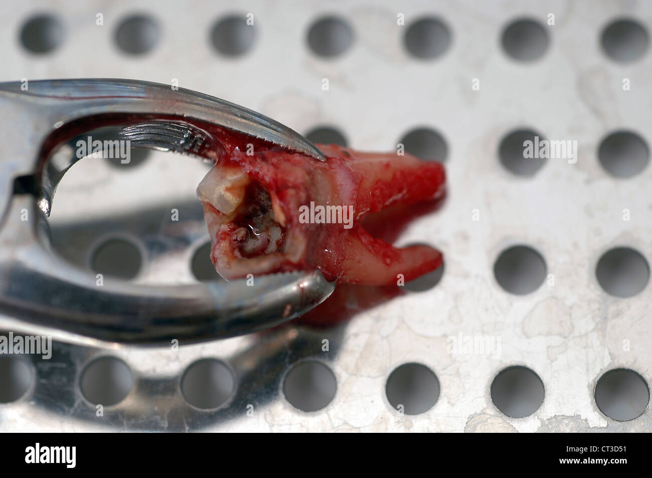 Ein verfallener Zahn, der frisch aus dem Mund des Patienten entfernt wurde. Stockfoto