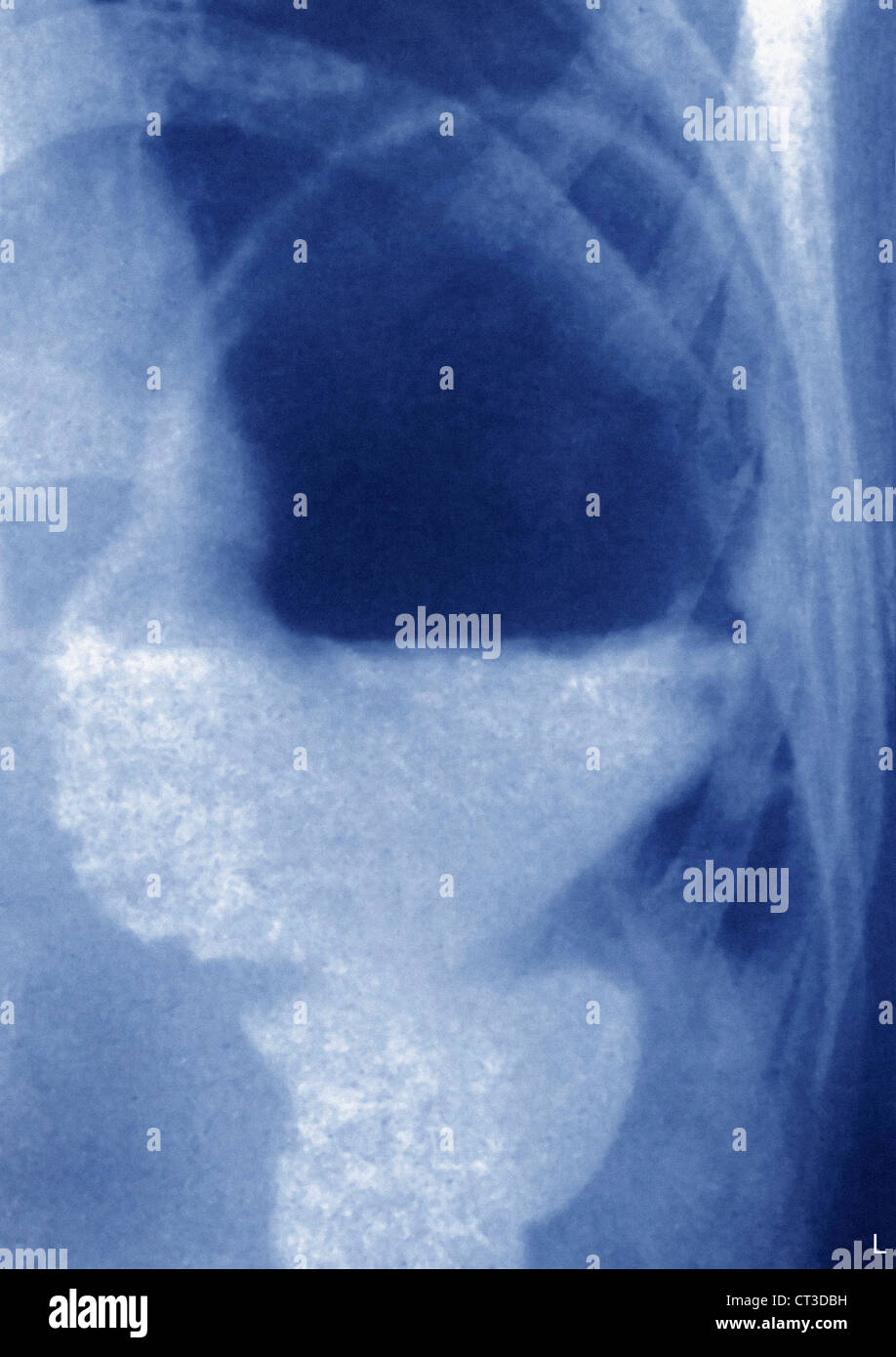 ZWERCHFELL-HERNIE, X-RAY Stockfoto