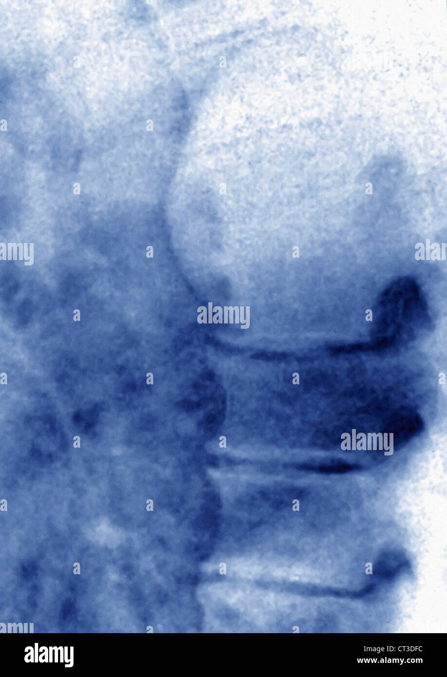 INTERCOSTALNEURALGIE SCHWANNOMA, XRAY Stockfotografie Alamy