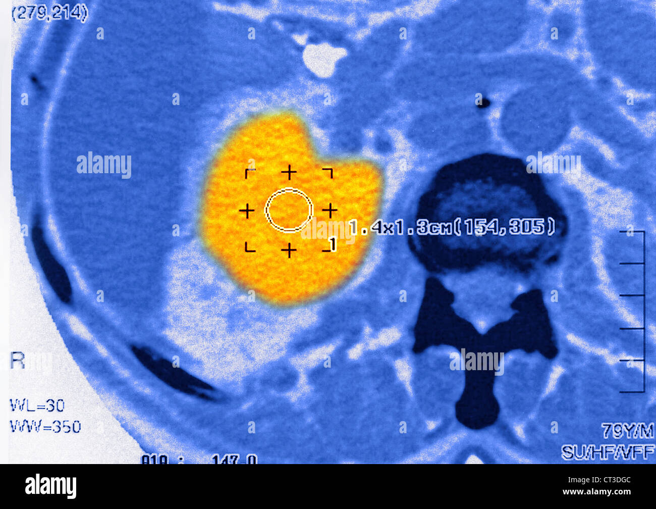RENAL CARCINOMA, SCAN Stockfoto RENAL CARCINOMA, SCAN Stockfoto