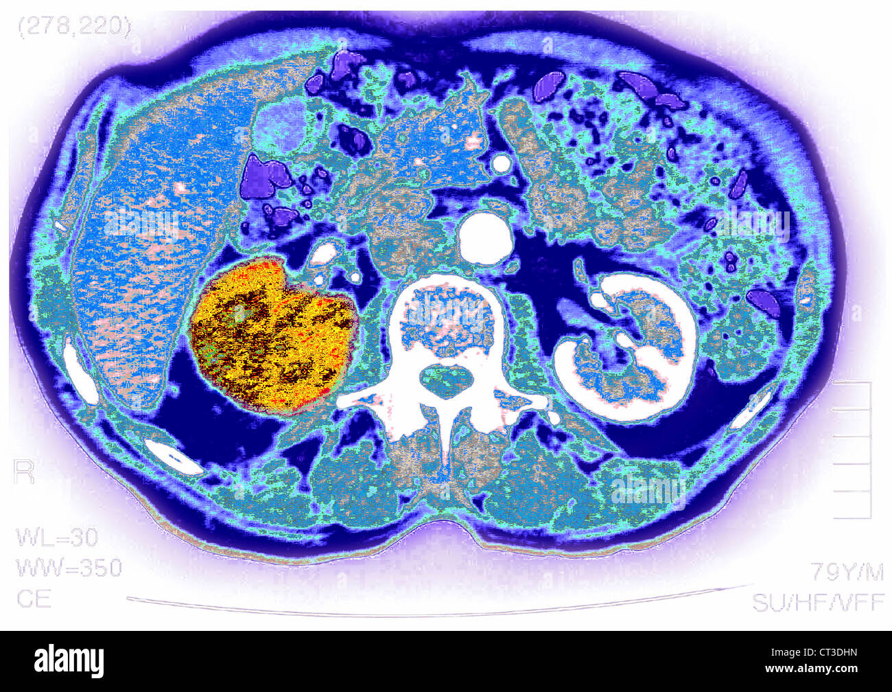 RENAL CARCINOMA, SCAN Stockfoto RENAL CARCINOMA, SCAN Stockfoto