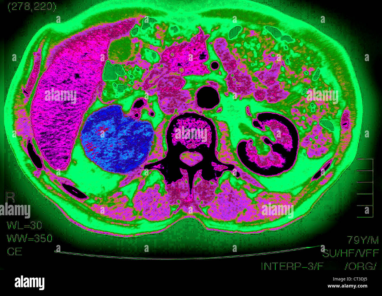 RENAL CARCINOMA, SCAN Stockfoto RENAL CARCINOMA, SCAN Stockfoto
