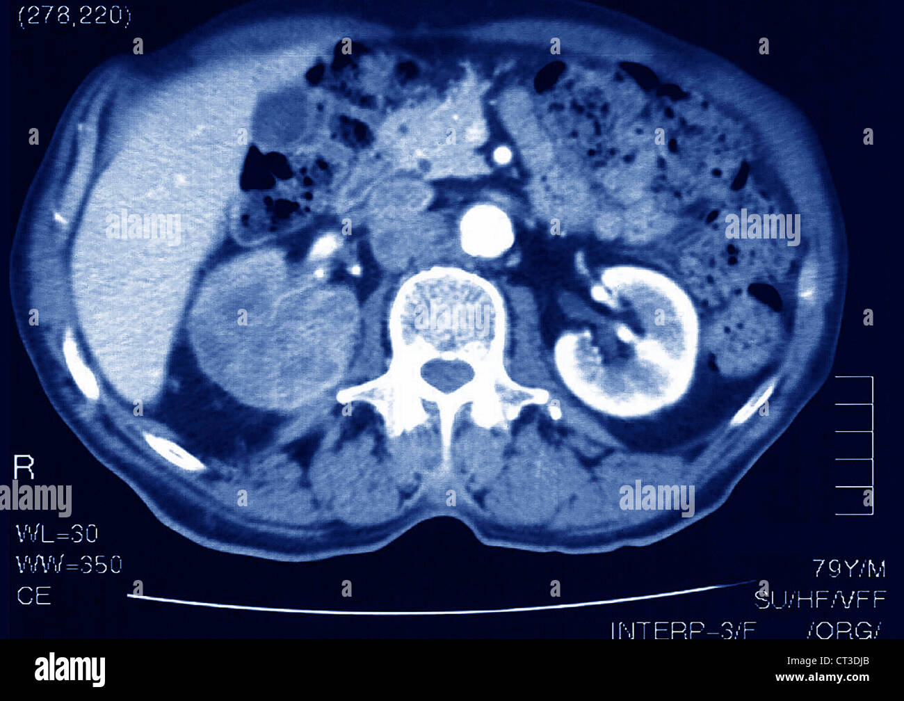 RENAL CARCINOMA, SCAN Stockfoto RENAL CARCINOMA, SCAN Stockfoto