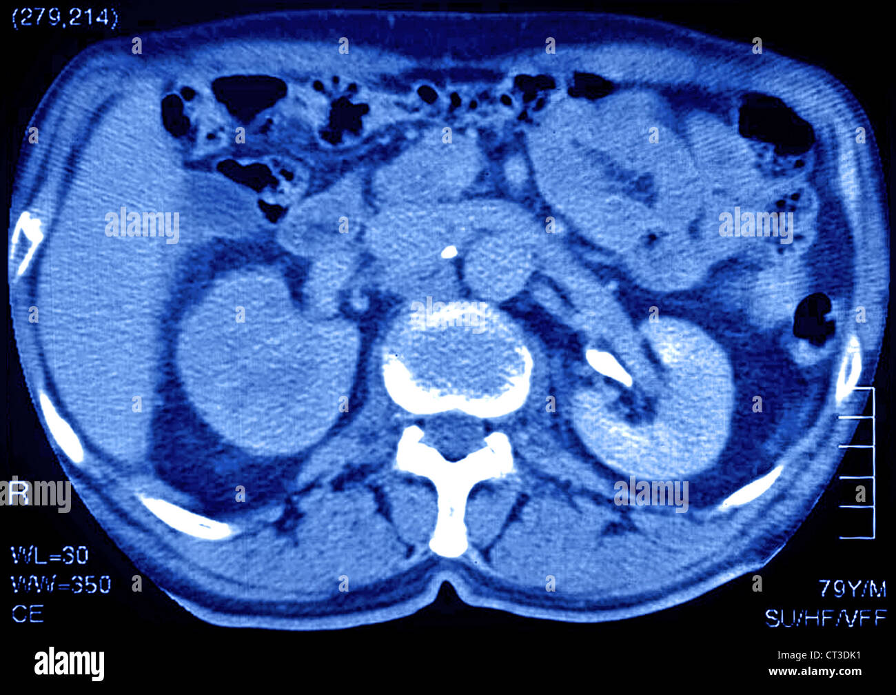 RENAL CARCINOMA, SCAN Stockfoto RENAL CARCINOMA, SCAN Stockfoto