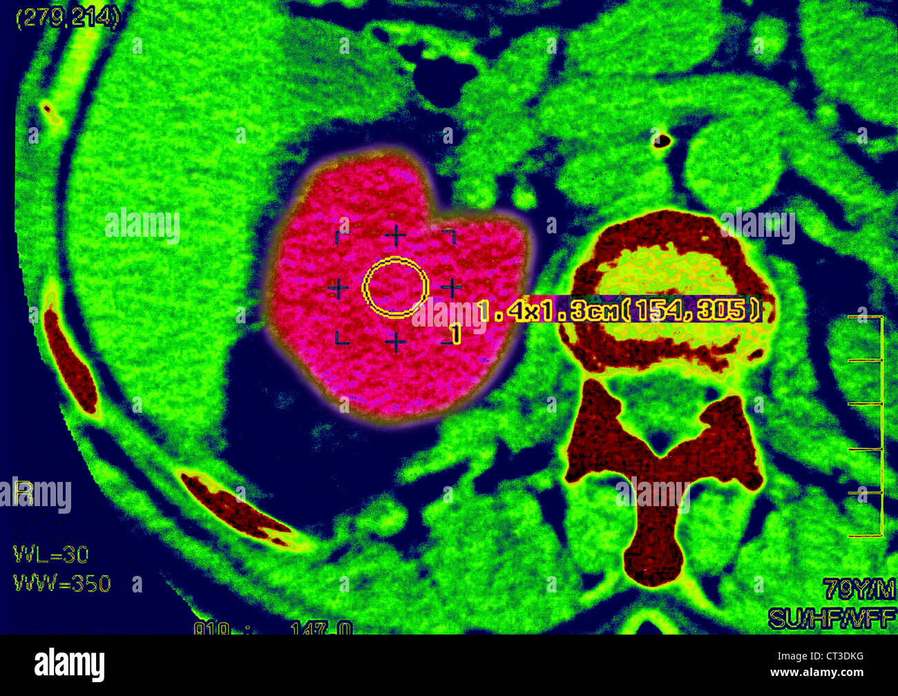 RENAL CARCINOMA, SCAN Stockfoto RENAL CARCINOMA, SCAN Stockfoto