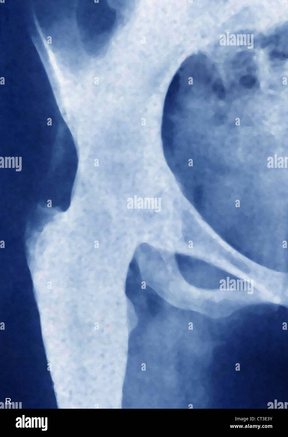 ARTHRITIS DER HÜFTE, X-RAY Stockfoto
