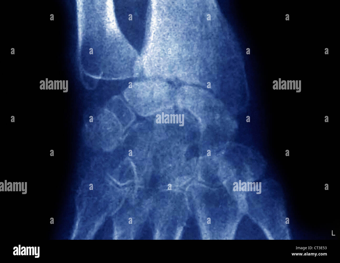ARTHRITIS HAND, XRAY Stockfotografie Alamy