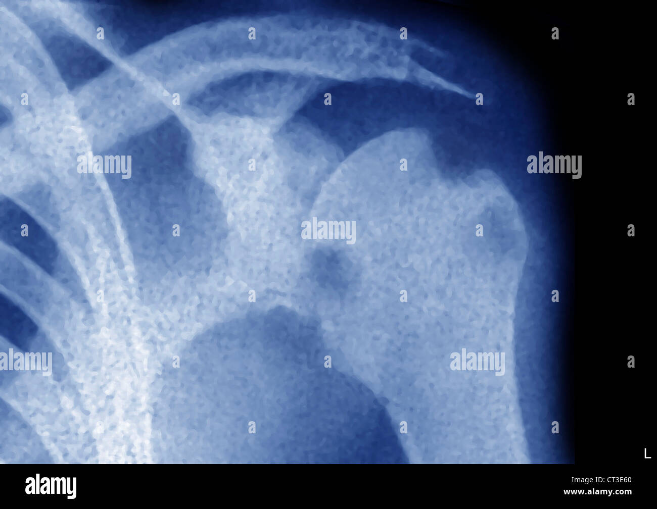 TUBERKULOSE IN DEN KNOCHEN, RÖNTGEN Stockfoto