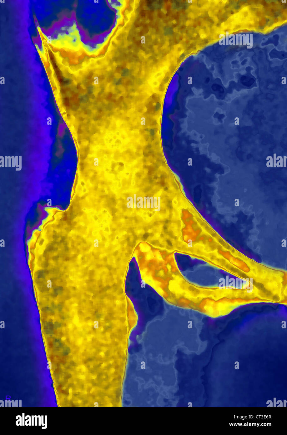 ARTHRITIS DER HÜFTE, X-RAY Stockfoto