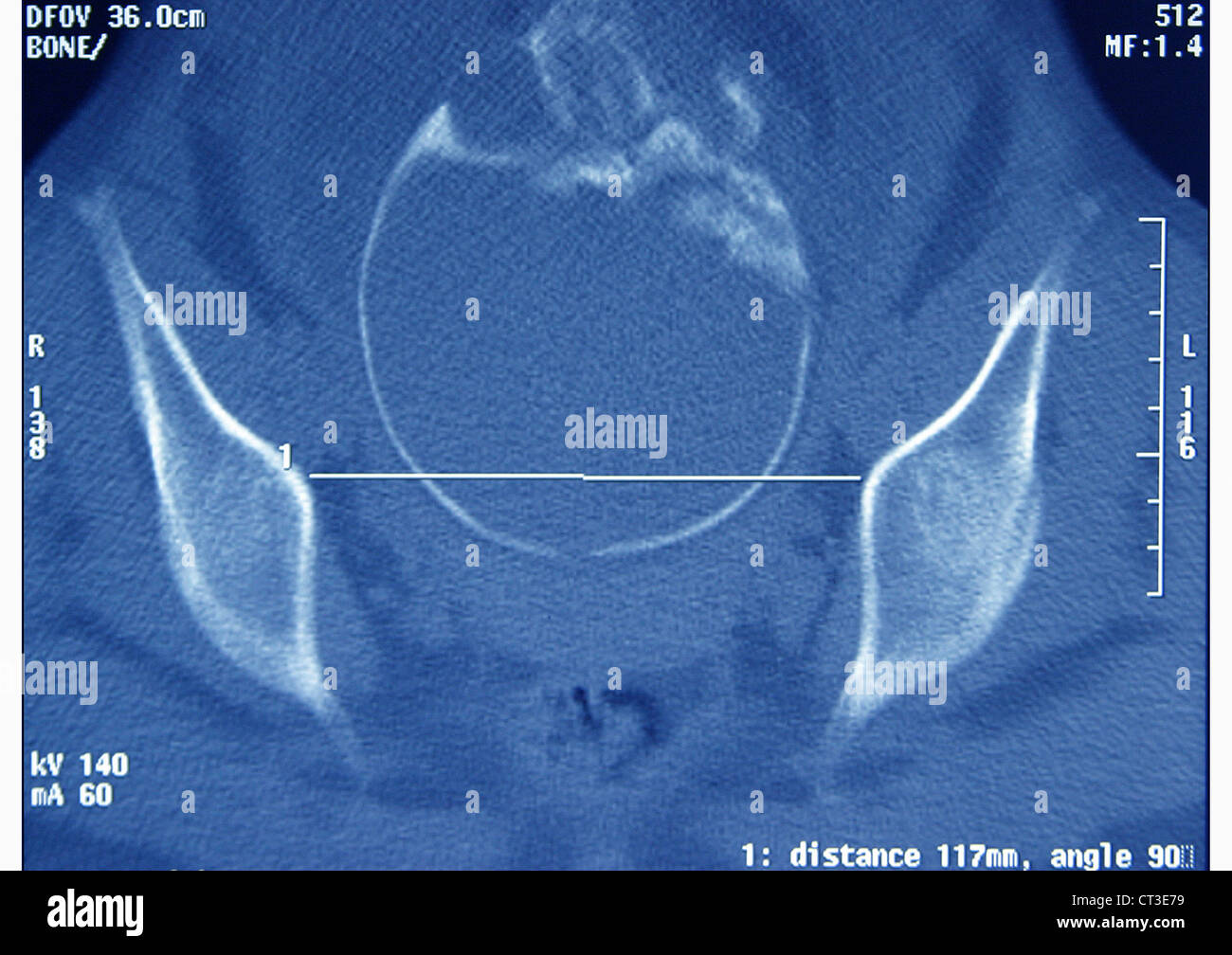 PELVIMETRY Stockfoto