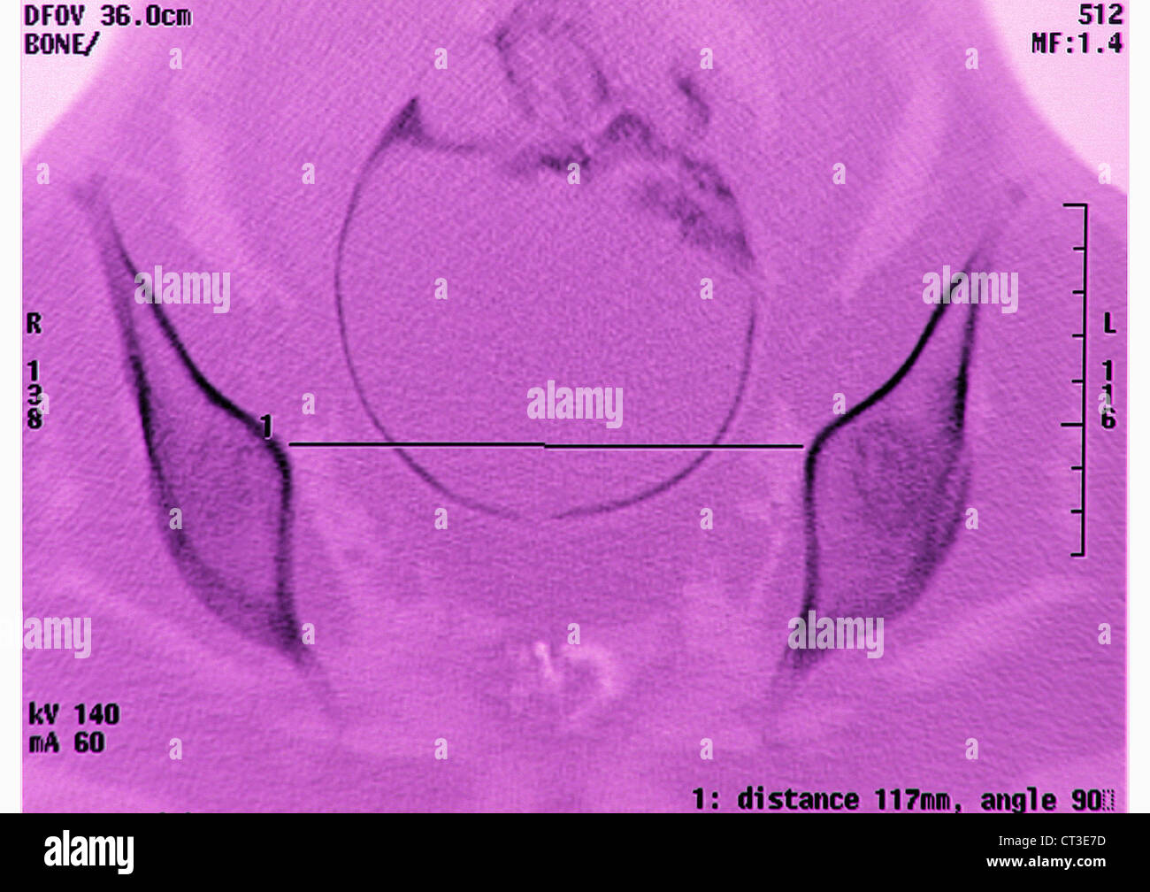 PELVIMETRY Stockfoto