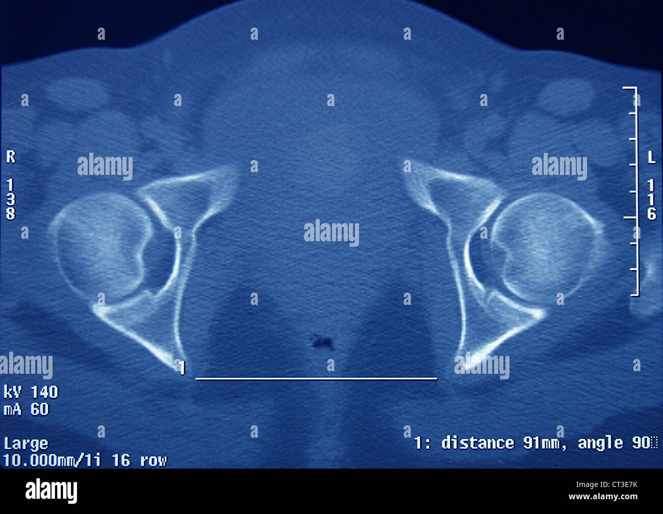 PELVIMETRY Stockfoto