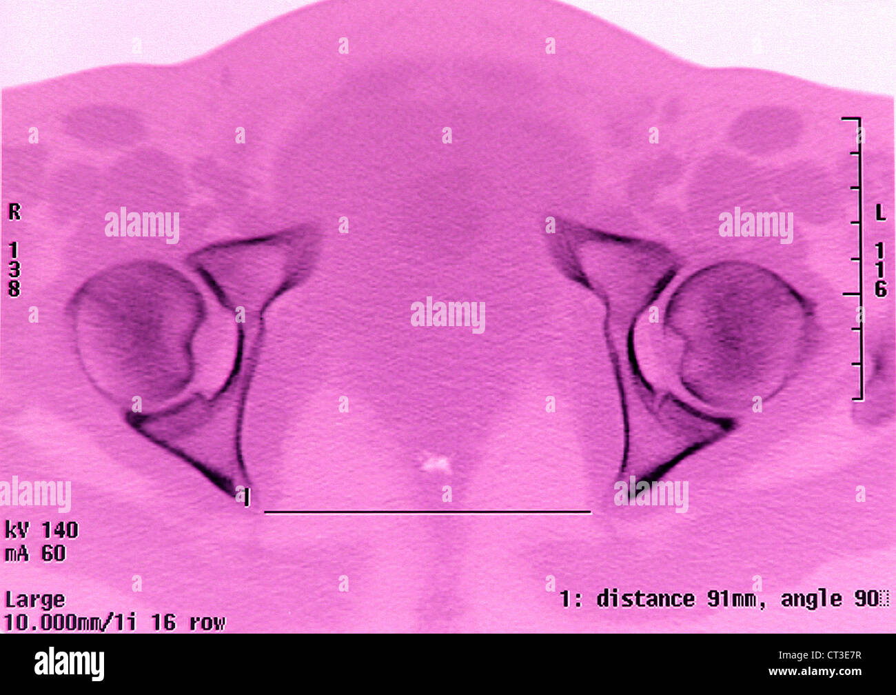 PELVIMETRY Stockfoto