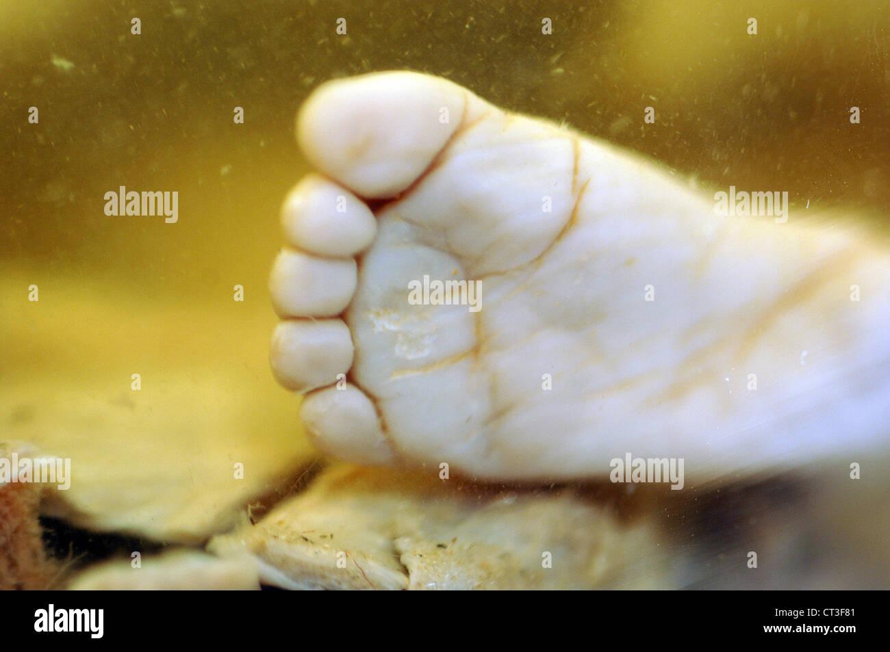 Der Fuß eines toten Fötus in Formaldehyd aufbewahrt. Stockfoto