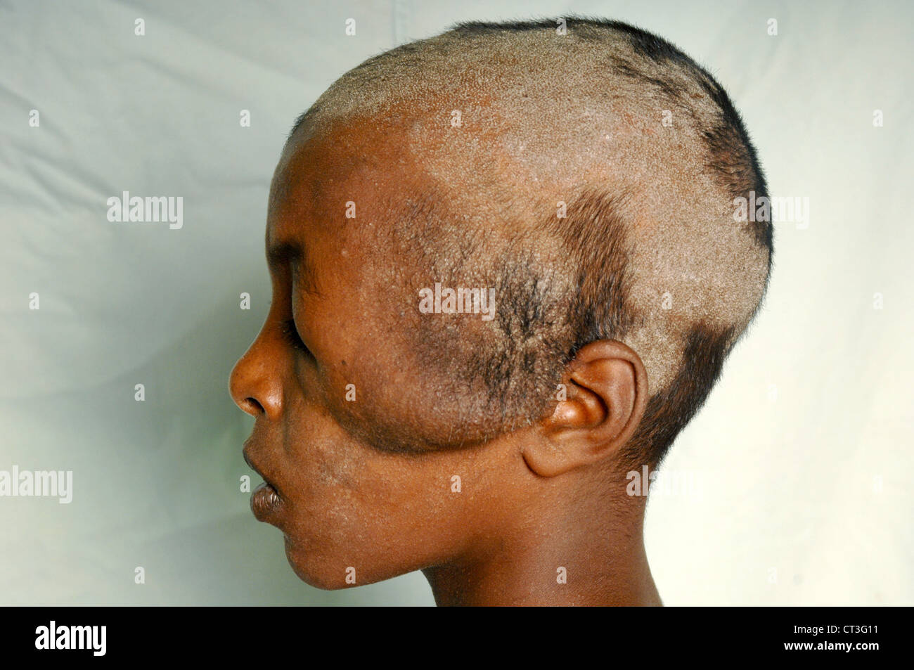 Seitenansicht eines 13 Jahre alten männlichen Neuro Hämangiom und Tinea Capitis - Soba, Sudan leiden. Tinea Capitis ist eine Pilzinfektion der Kopfhaut, besser bekannt als Scherpilzflechte. Stockfoto