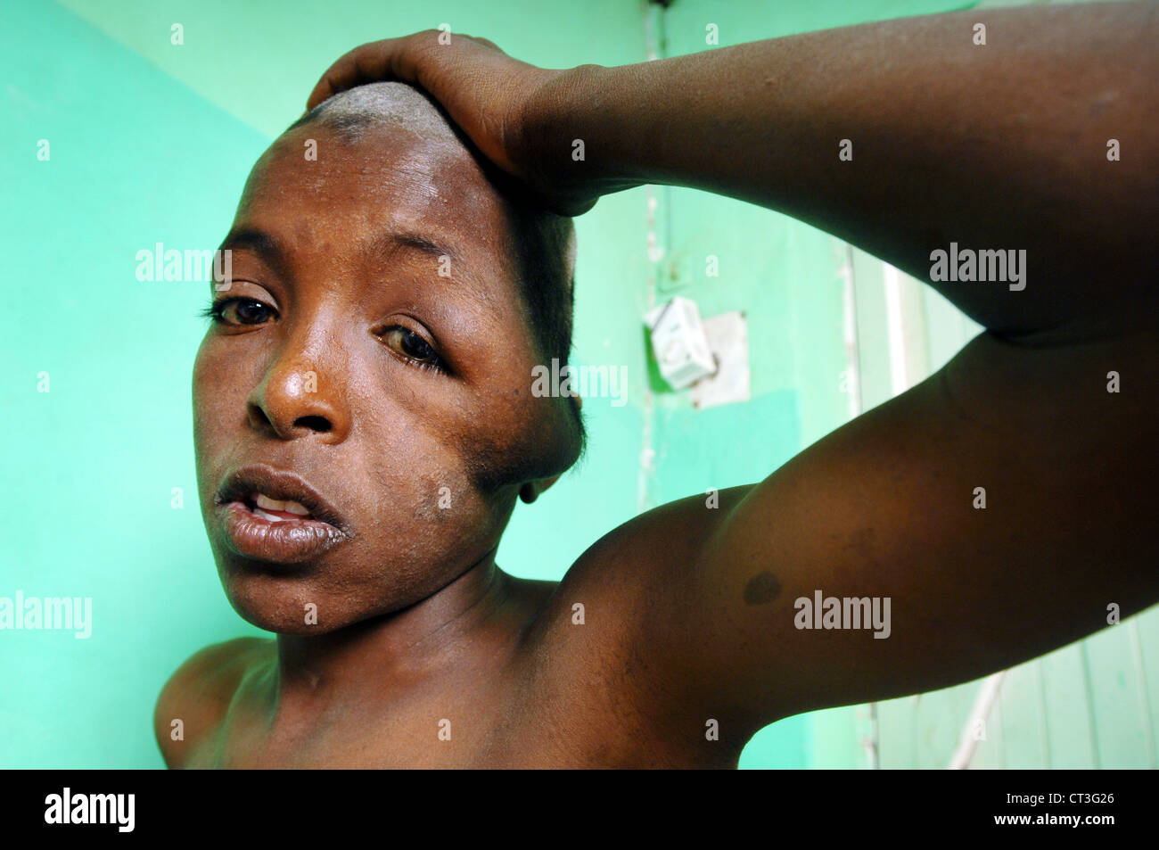 Ein 13-Year-Old Mann mit Rhabdomyosarkom und schweren Seborrhagic Dermatitis. Tinea Capitis ist eine Pilzinfektion der Kopfhaut, besser bekannt als Scherpilzflechte. Stockfoto